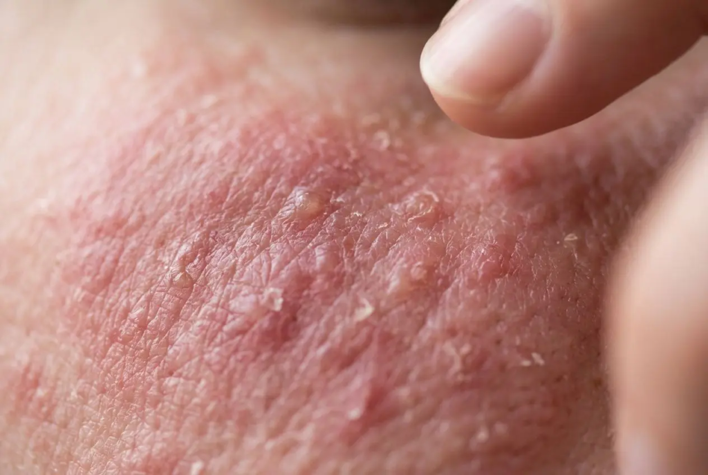 Portrait d’une peau irritée et rouge avec des squames légères, proche d’un doigt en repoussant la zone, évoquant une malaisie de peau psychosomatique.