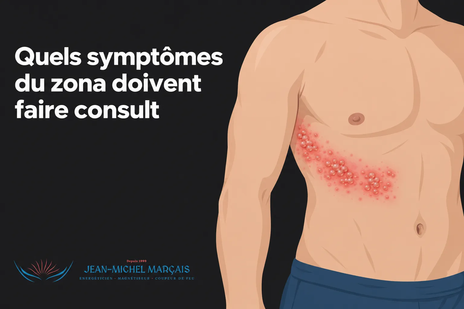 Zona et stress : quel lien et quel traitement ? 2 Éruption rouge et douloureuse sur le côté droit du thorax avec des ampoules groupées apparaissant sur la peau.